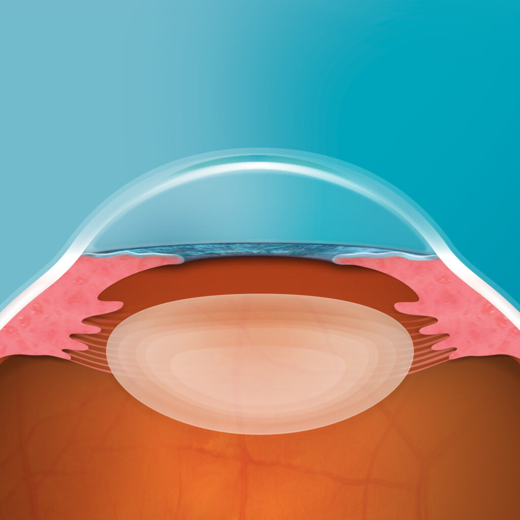 Illustration of eye with EVO ICL Lens